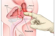 tratamentul prostatitei prin uretra